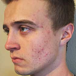 proactiv teenage acne