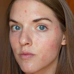 proactiv teenage acne