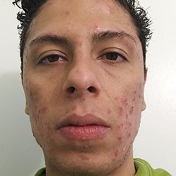 ProactivMD Results: Martin Before