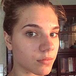 ProactivMD Results: Sabrina Before