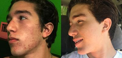 proactiv teenage acne