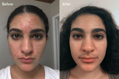 proactiv for sensitive skin