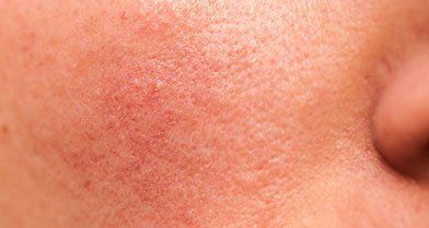 How to Get Rid of Acne | Acne Causes, Types & Treatments | Proactiv®